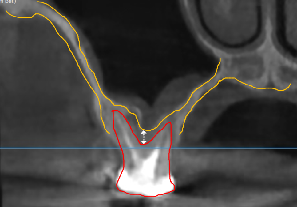Sinusitis Caused by Teeth: Why Do You Tell Me to Go to the Dentist When My Nose Hurts? image 2
