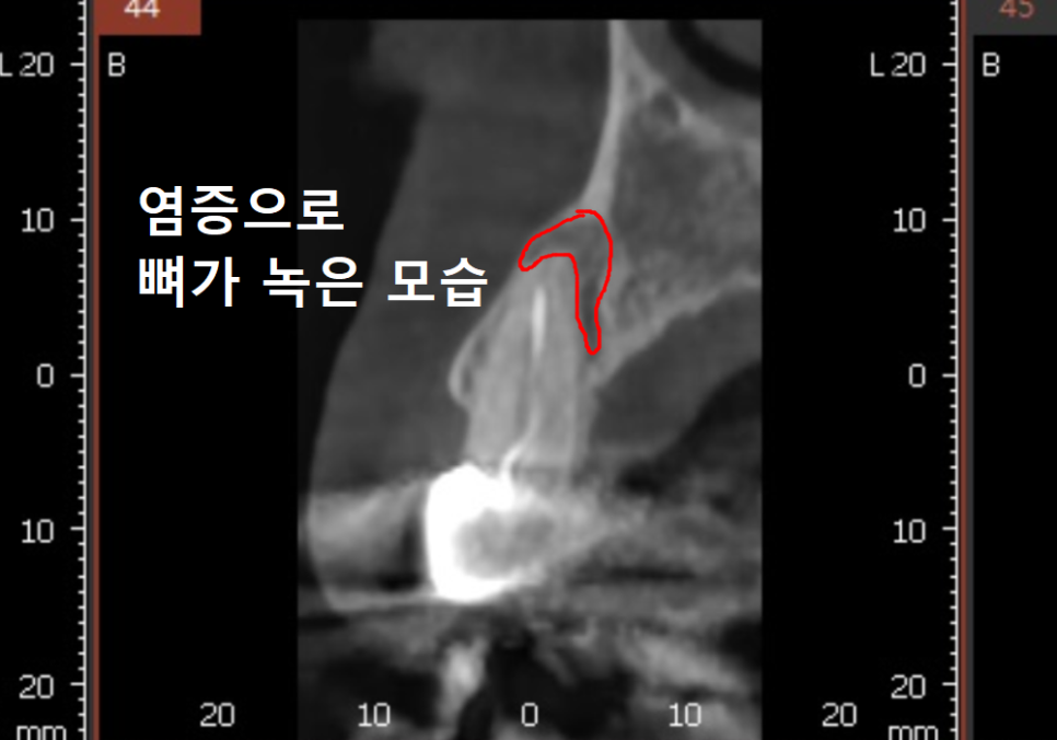 앞니 브릿지 탈락, 씌워둔 게 빠졌어요. 다시 붙일 수 있을까요? 관련 이미지 14