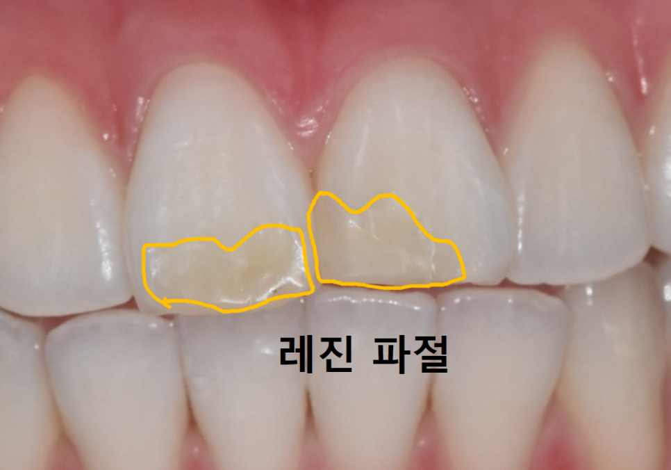 절단교합으로 인한 앞니 레진 깨짐, 교정 없이 해결한 사례 관련 이미지 5