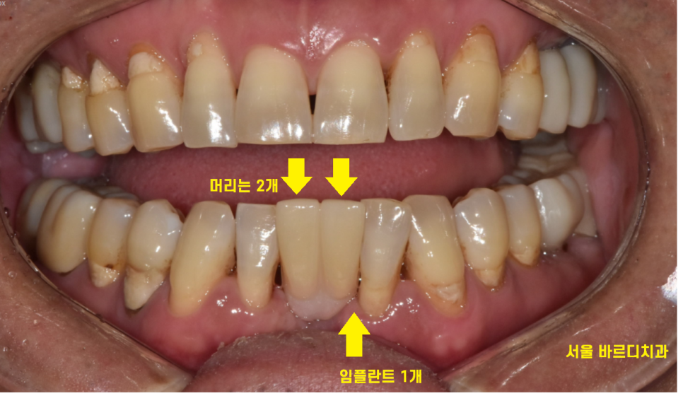 둔촌동 치과 아래 앞니 임플란트 뼈가 없을 때 일체형으로! 관련 이미지 8