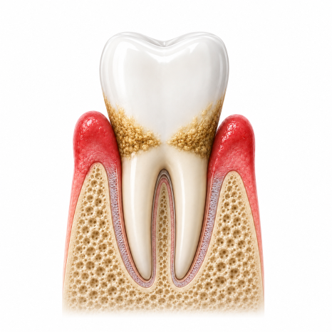 My Teeth Feel More Sensitive After Scaling (+ Causes and Ways to Reduce Sensitivity) image 7