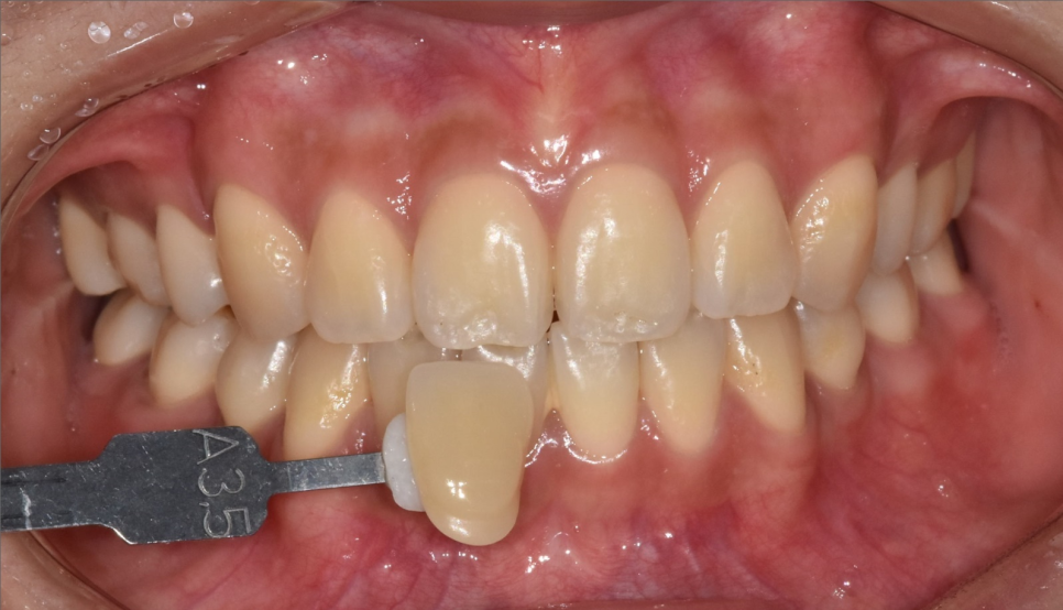 강동구 치아 미백 과정 확인하고 환한 미소로 웃어봐요 우리 관련 이미지 8