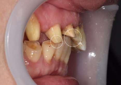 고덕동 심미 보철, 삐뚤어진 앞니, 교정 없이 바로잡은 비결 관련 이미지 11