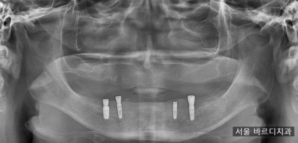 임플란트 틀니 치아가 없을 때 하남미사치과에서 해결하세요. 관련 이미지 1