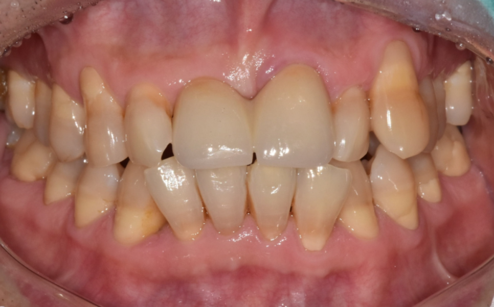 잇몸 내려감으로 길어진 치아, 방치하면 안 되는 원인, 증상, 이유 관련 이미지 12