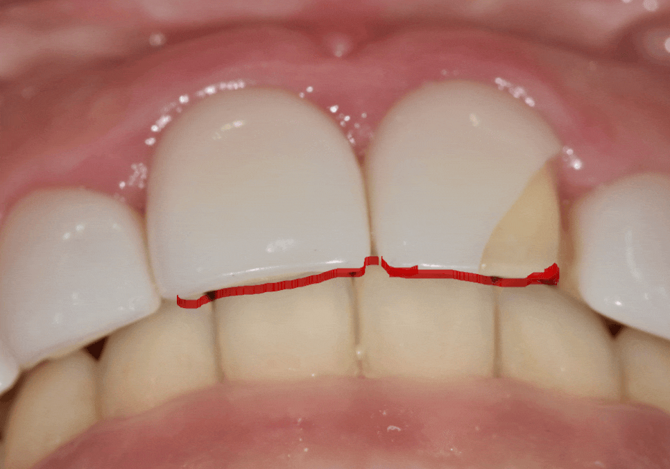 천호 라미네이트 파절 탈락, 줄이려면 치과 선택이 중요합니다. 관련 이미지 8