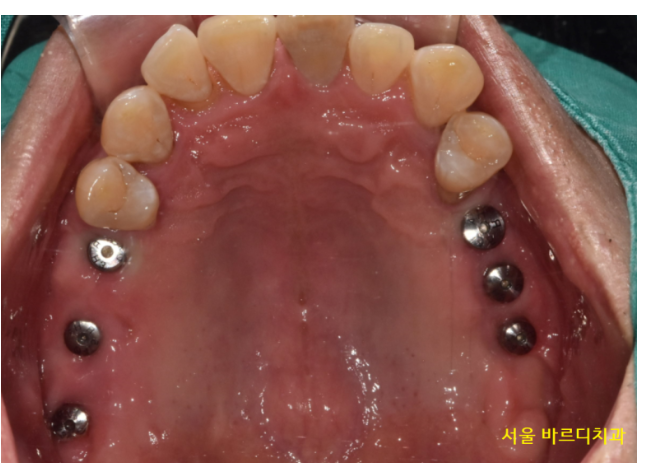 길동 치과 임플란트 뼈이식 후 흡연 상관 있을까? 관련 이미지 10