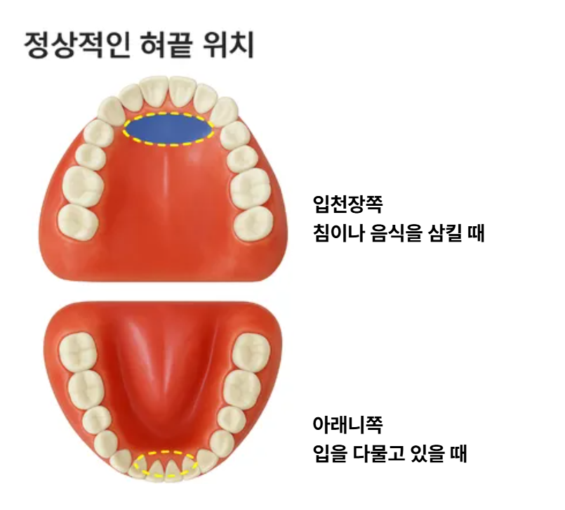 개방교합 재발 치료보다 유지가 어렵기에 혀 습관 교정이 핵심입니다. 관련 이미지 6