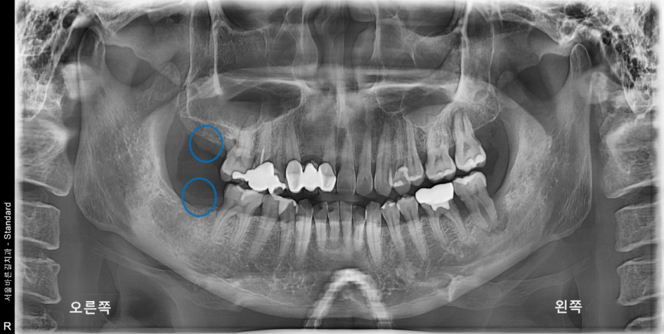 상일동치과 서울바르디치과 무절개 네비게이션 임플란트 치료증례 #7 관련 이미지 3