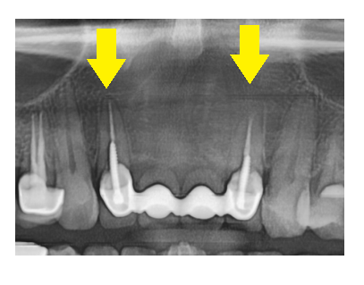 앞니 잇몸 검은색 라인 오래된 pfm 보철 교체하세요!! 관련 이미지 6