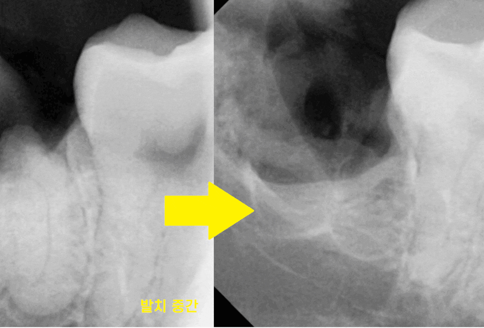 상일동 사랑니 맨날 뽑아야지는 그만!! 매복 치아도 깔끔하게 뽑으세요 관련 이미지 1