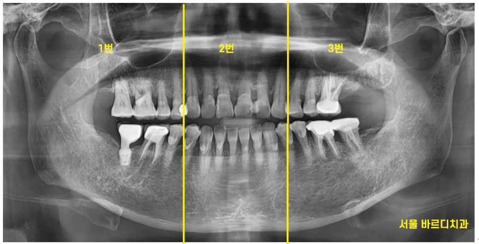 고덕동 치과 어금니 흔들림과 통증 임플란트가 답일 때! 관련 이미지 5