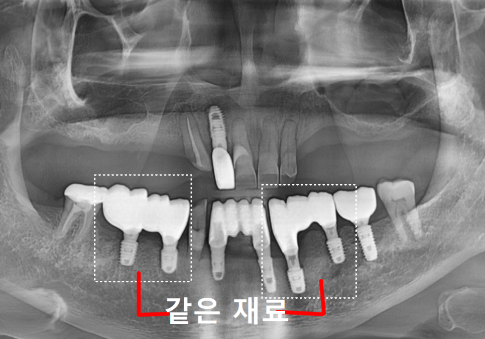 Cheonho Dental Clinic, Are You Over 65? We’re Revealing How to Reduce Denture and Implant Costs. image 13
