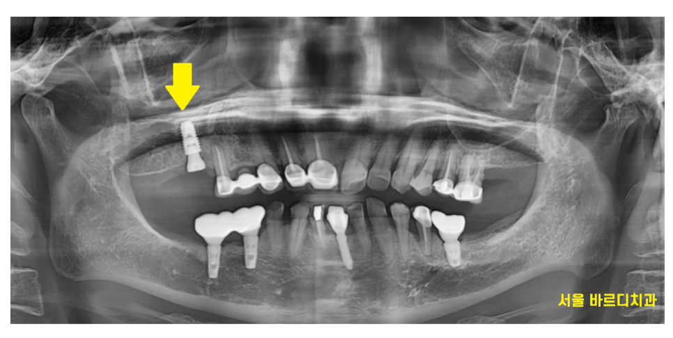 암사동 치과 골다공증 치료 중 임플란트 가능한가요?? 관련 이미지 8