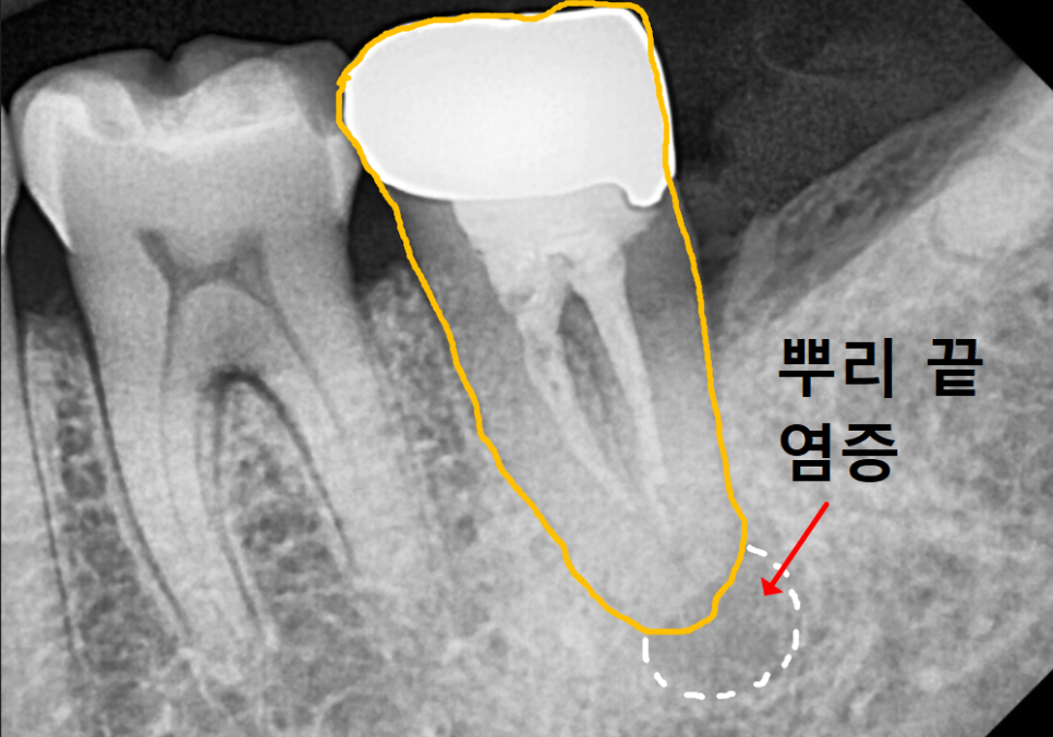 어금니 염증, 자연치 살리기에 진심인 저는 이렇게 살렸습니다. 관련 이미지 2