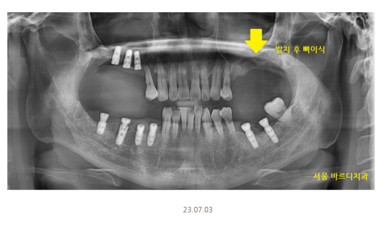 길동 치과 임플란트 뼈이식 흡연 관련 있을까? 관련 이미지 8