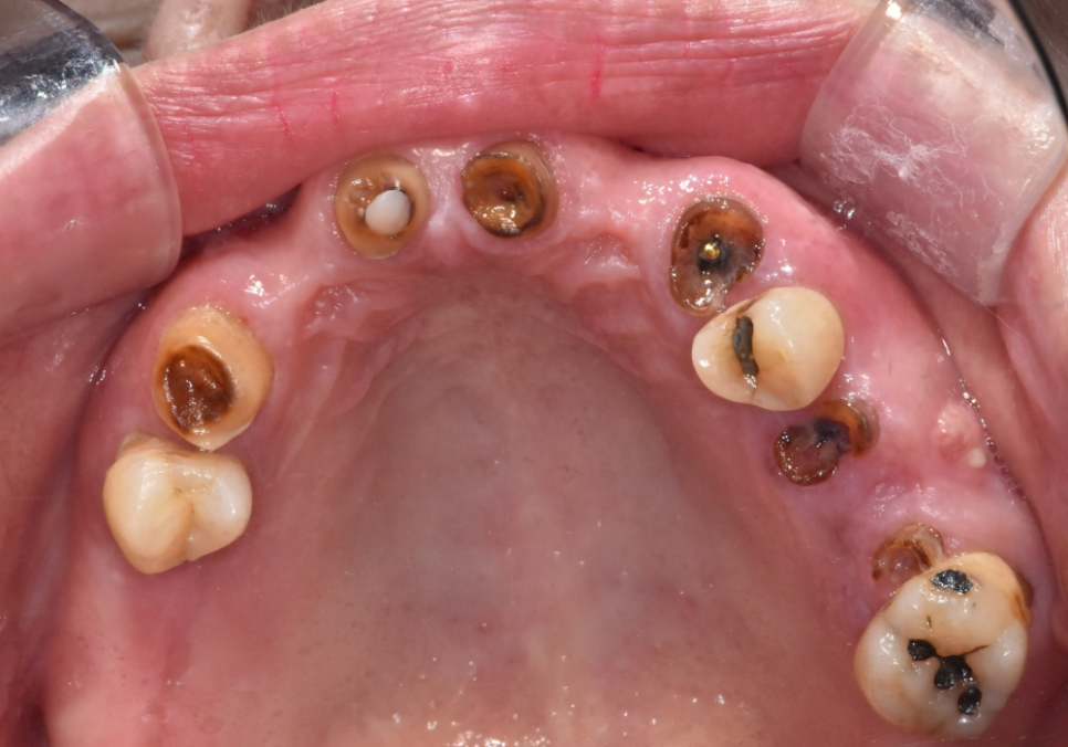 뿌리만 남은 치아, 그대로 두면 왜 위험할까요? 고덕동 전체 임플란트 재건 사례 관련 이미지 4