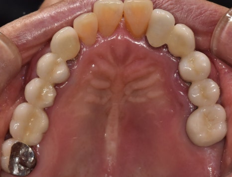 A Pimple Outside the Gums: Bridge Retreatment Implant Case Due to Bone Loss image 4