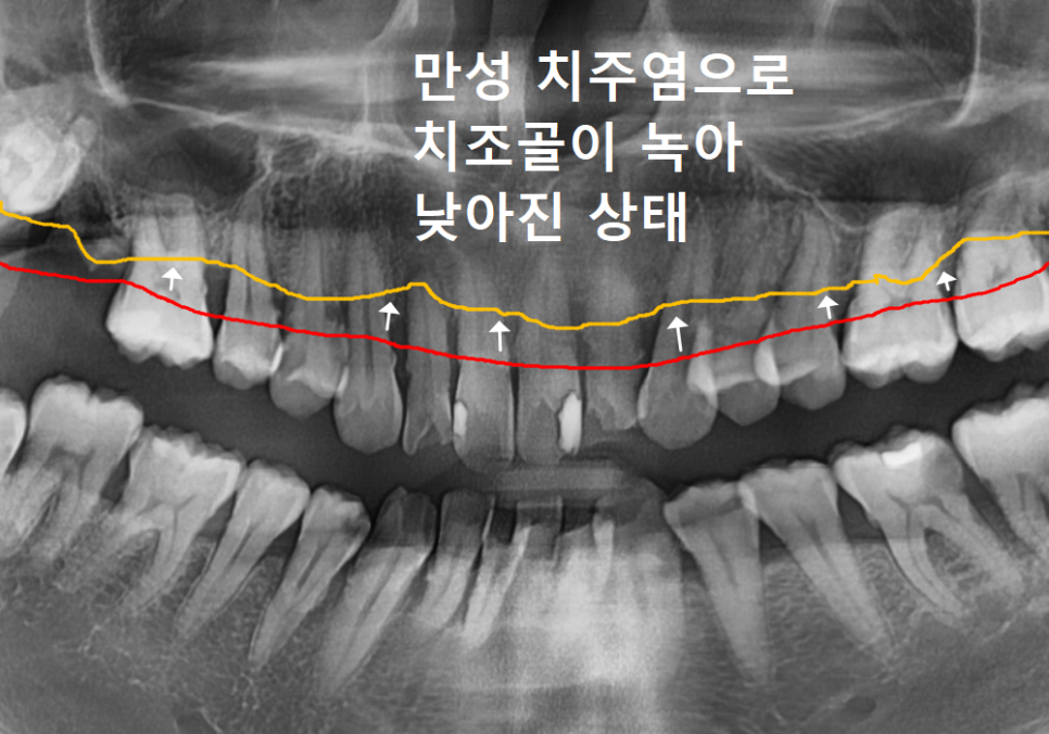 강동구 앞니 충치, 누구는 레진이고 누구는 임플란트인 관련 이미지 3