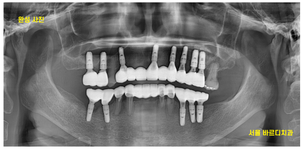 강동구 임플란트 어금니 상실 방치하다 치매까지 옵니다. 관련 이미지 12