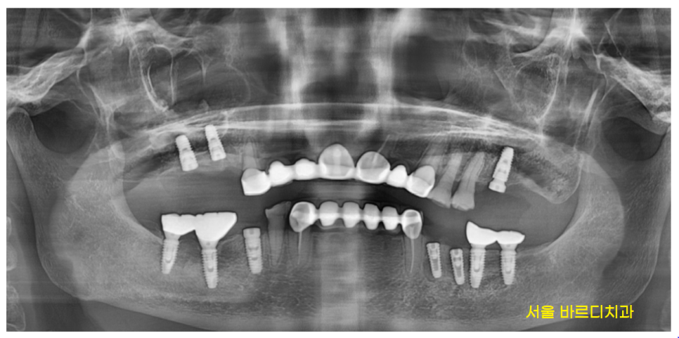 명일동 치과 임플란트 치료 기간 얼마나 걸릴까요??? 관련 이미지 7