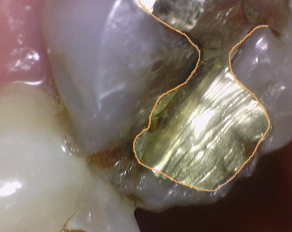 풍산동 치과 골드 인레이 치료했던 치아가 또 충치가 생김. 관련 이미지 3