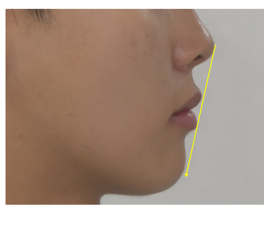 앞니 뻐드렁니 비발치 교정으로 가능합니다. 관련 이미지 6
