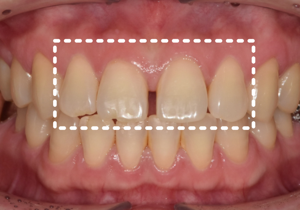 고덕동 치간 이개, 위 앞니 벌어짐, 교정? 라미네이트? 고민이시라면 필독 관련 이미지 6