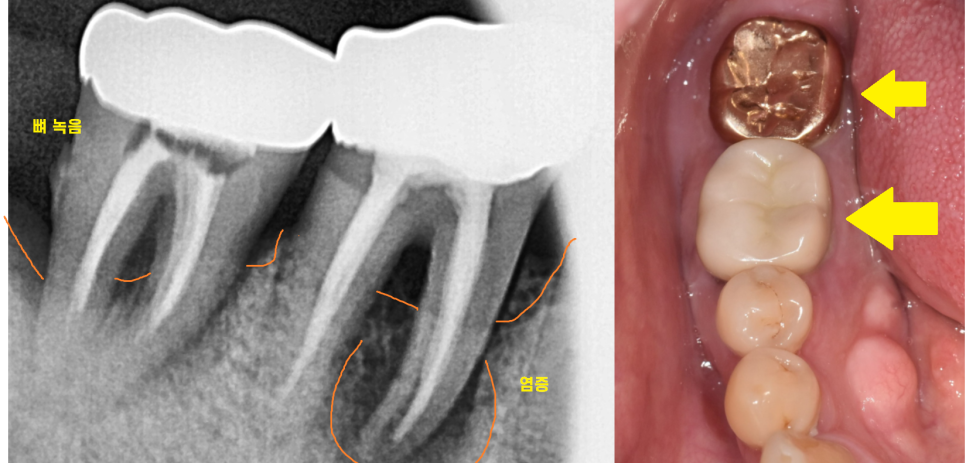 치과 엑스레이 꼭 찍어야하나요? 암사역 치과에서 답변드립니다. 관련 이미지 3