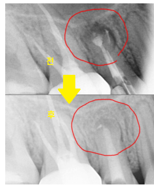 망월동 치과 재신경치료 자연치아 살리기 끝판왕 치료 mta로 가능했습니다. 관련 이미지 10