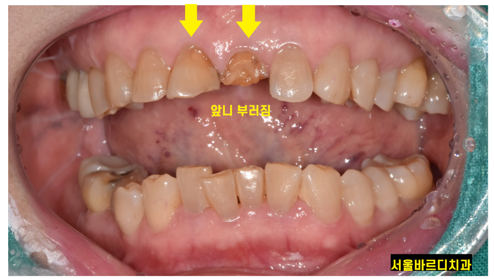 길동 치과 임플란트 수술 대안은 없을까요???? 관련 이미지 5