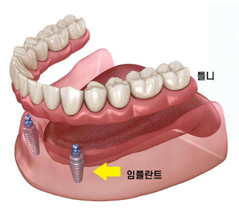 임플란트 틀니 치아가 없을 때 하남미사치과에서 해결하세요. 관련 이미지 2