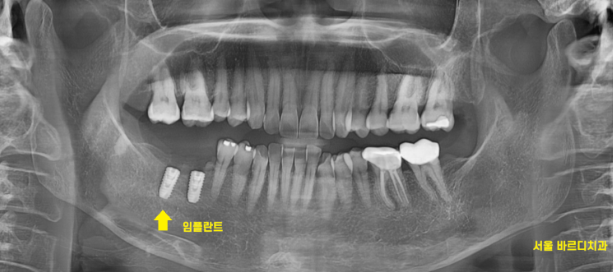 상일동역 치과에서 알려드리는 임플란트 수술과정 대공개 관련 이미지 8