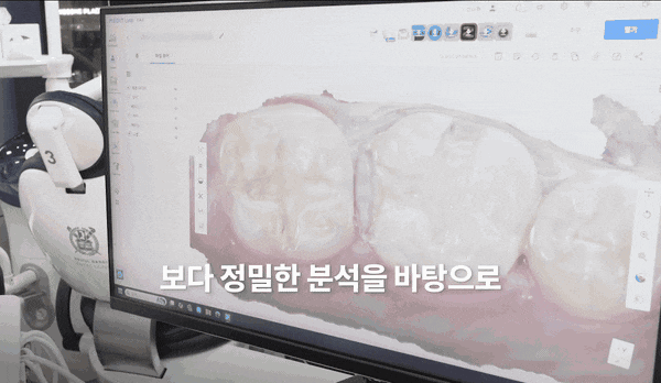 투명교정 vs 철사 교정, 차이점과 적합한 사람 정리해 드립니다. 관련 이미지 4