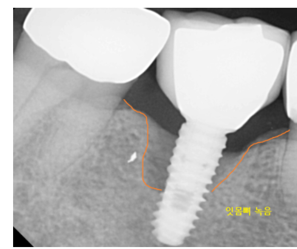 임플란트 사후관리 다른 병원 것도 수리 가능한 경우 정리해드립니다. 관련 이미지 5