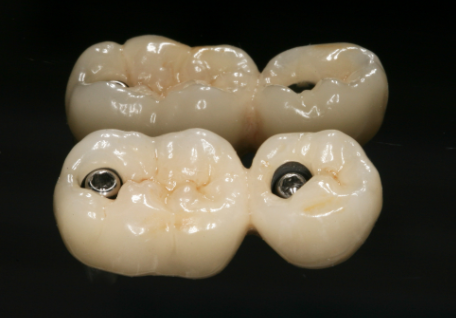 고덕동 임플란트 크라운 연결해서 만드는 이유는? 관련 이미지 2