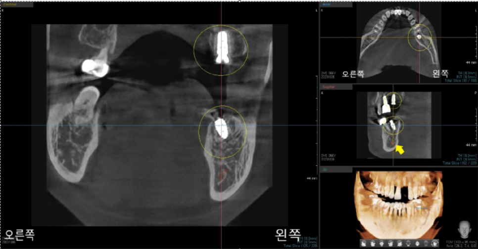 상일동치과 서울바르디치과 무절개 네비게이션 임플란트 치료증례 #3 관련 이미지 6