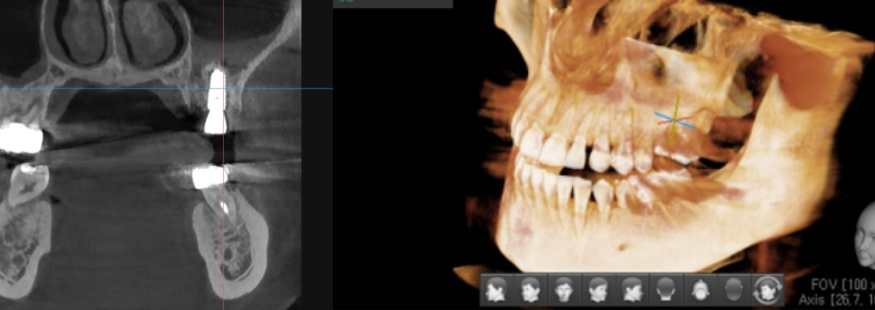 디지털 임플란트 체계적인 수술이 가능한 서울바르디치과입니다. 관련 이미지 8