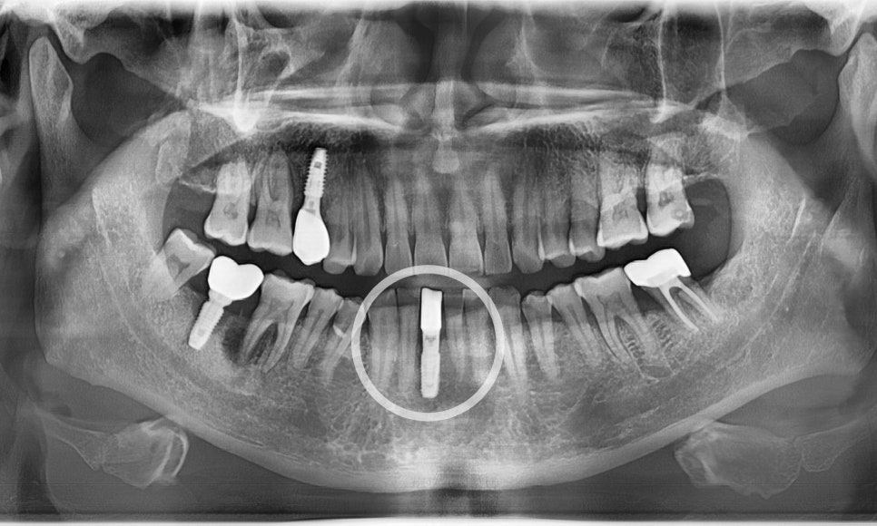 My Teeth Are Shaking So Much That Eating Is Uncomfortable—Is It Okay to Just Leave Them Alone? image 12