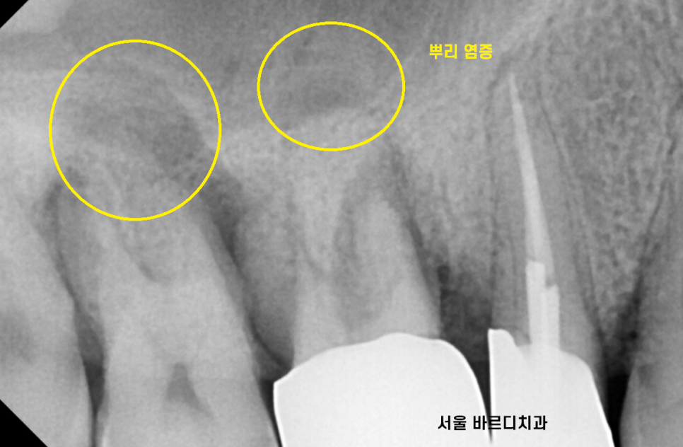 상일동 임플란트 치아 솟음으로 불편함을 느낄 때 관련 이미지 3