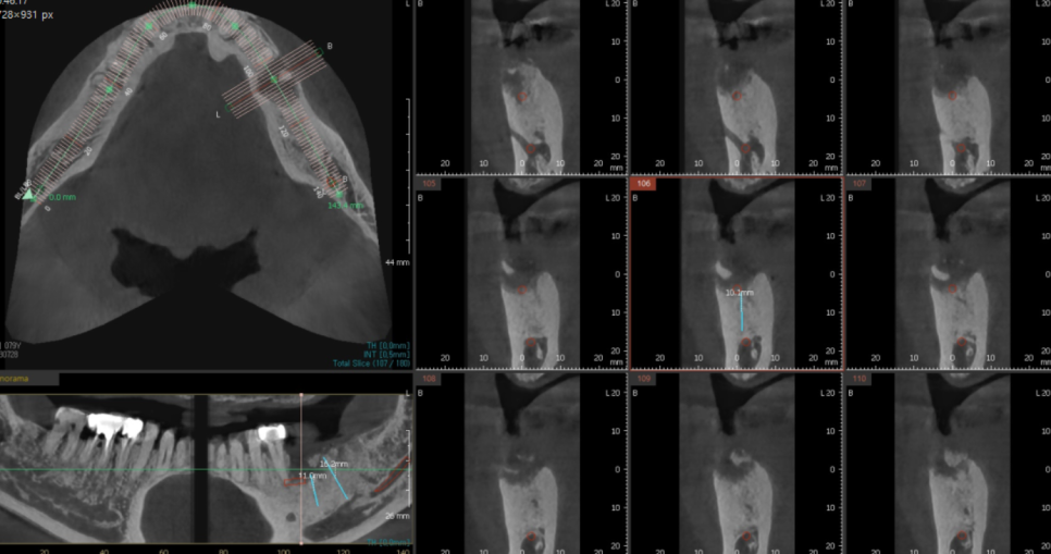 둔촌동 치과 80대 임플란트 가능한가요? 관련 이미지 9