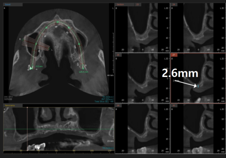 뼈가 없어서 안 된다구요? 70대 당뇨 무치악 환자분의 전체 임플란트 사례 관련 이미지 7