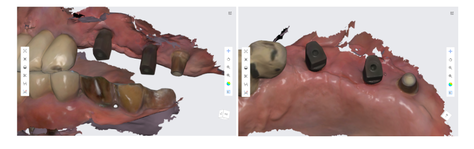 천호동 임플란트 앞니가 왜 어렵다는거죠? 수술이 안된다는데... 관련 이미지 5