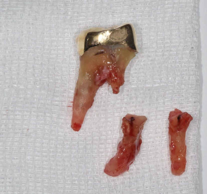 망월동 치과 염증이 심하면 임플란트 바로 못심어요 잇몸뼈 함몰 케이스 관련 이미지 5