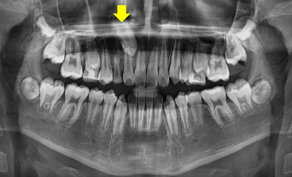 Pediatric Orthodontic Treatment for Impacted Canines Is Needed to Guide Proper Eruption. image 2