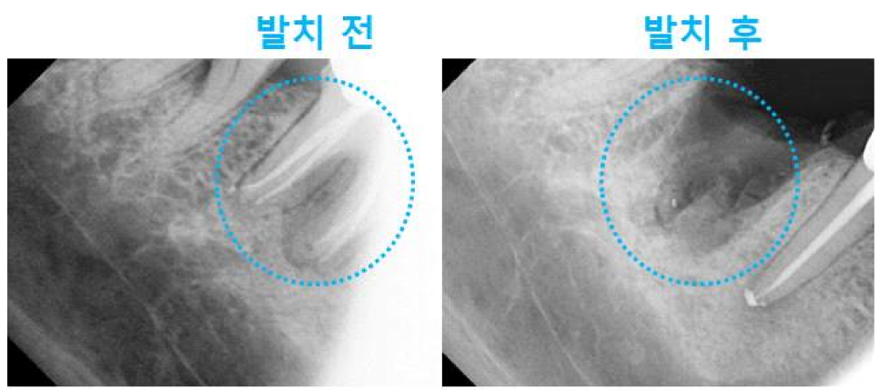 서울바르디치과 상하악 대구치 네비게이션 임플란트 치료증례 #4 관련 이미지 10