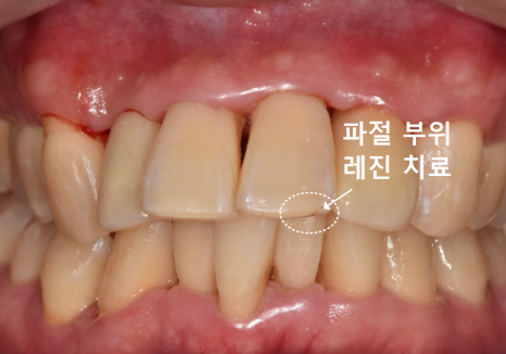 강동구 앞니 충치, 누구는 레진이고 누구는 임플란트인 관련 이미지 14