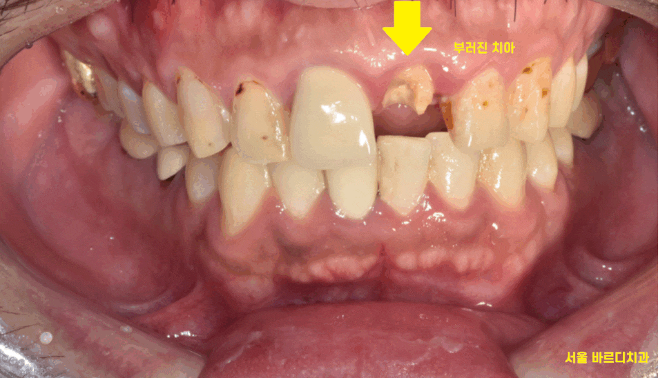 앞니 부러짐 손상이 커서 하남선동치과에서 임플란트 치료 관련 이미지 1