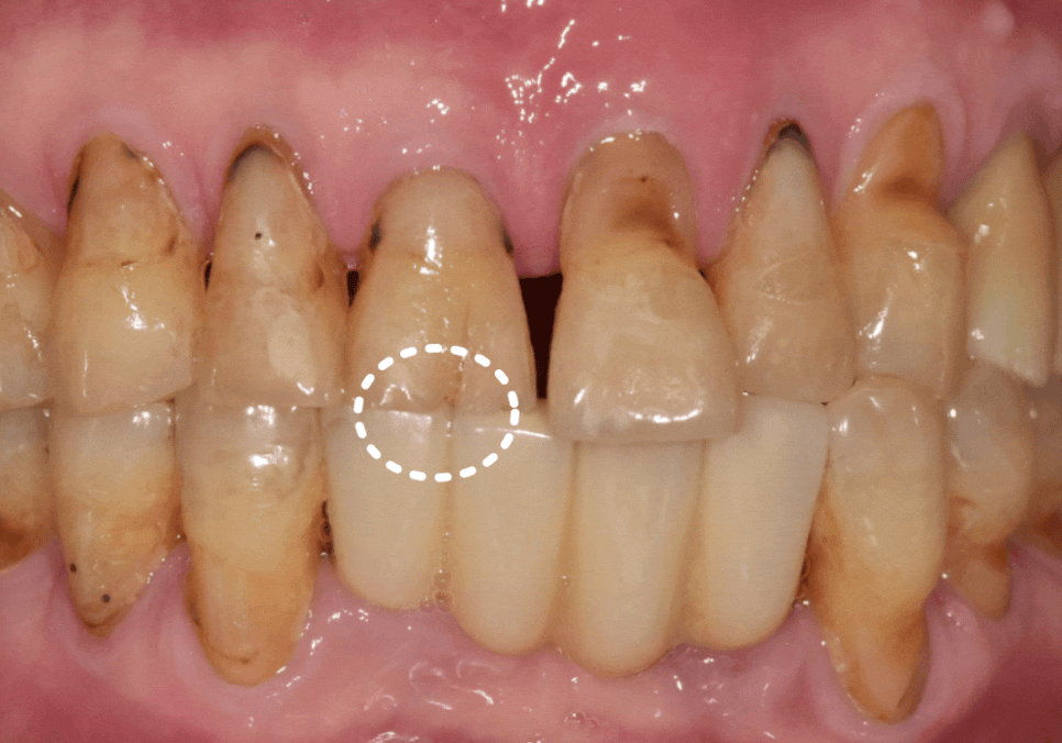 명일동 라미네이트 vs 크라운, 수명을 좌우하는 선택 기준 3가지 관련 이미지 2