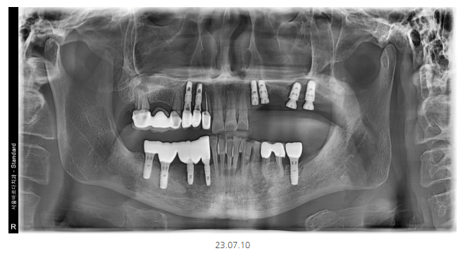 미사 임플란트 70대 연령과 상관없는 치료 과정 관련 이미지 7